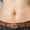 Postpartum Stretch Marks: How to Get Rid of Them?